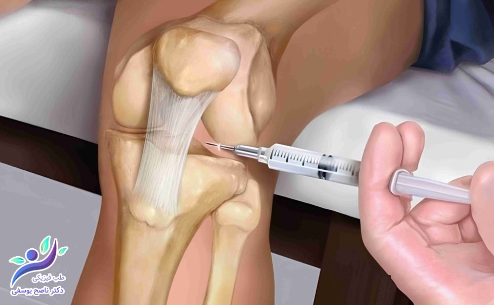 محلول پی‌آرپی (PRP) تهیه شده از پلاسمای خون 