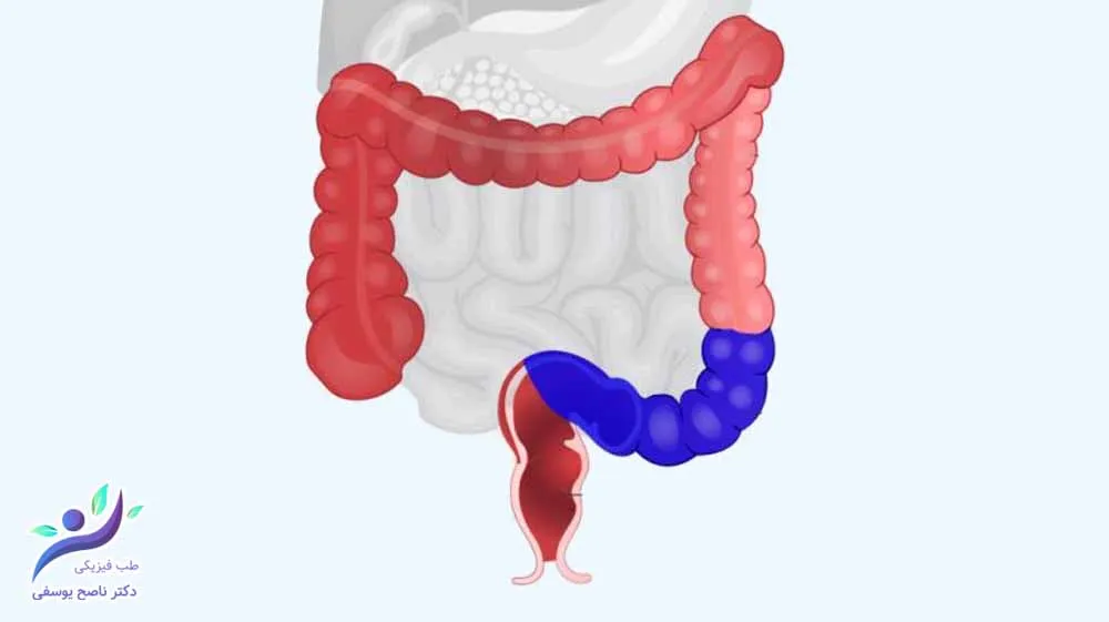 سندرم روده تحریکپذیر