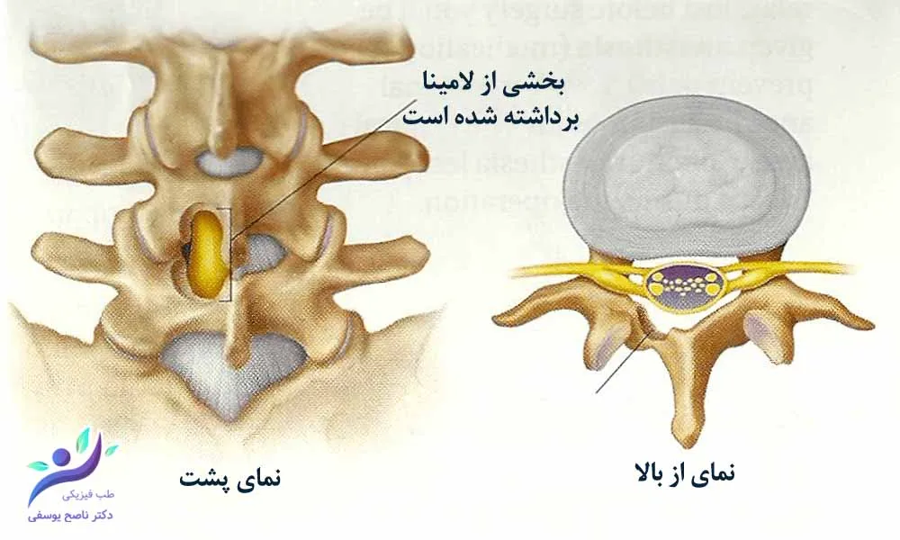 لامینوتومی